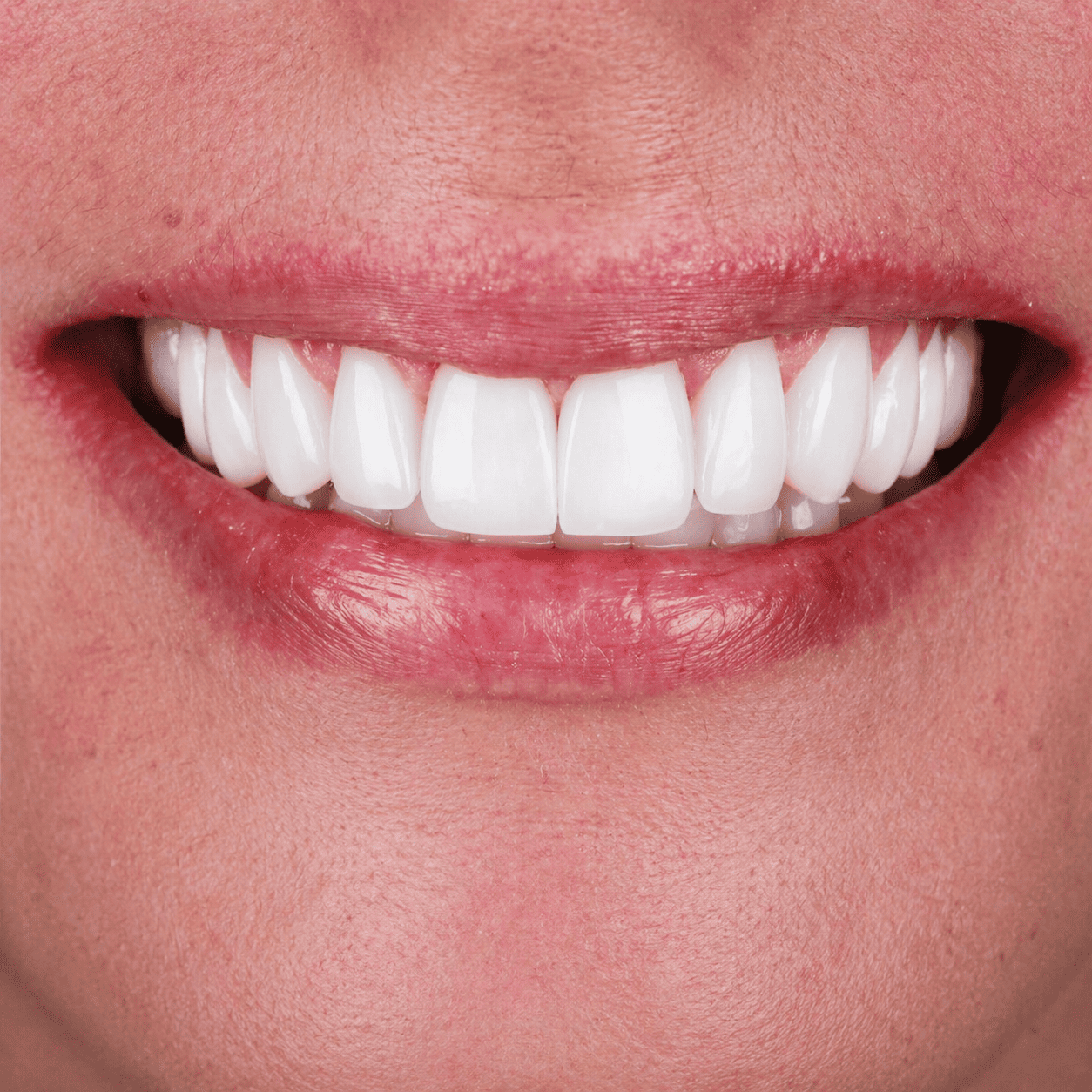 Cambio De Diseno De Resina Por Porcelana Imax En Un Tono Mas Plano Sin Efectos Traslucidos 1