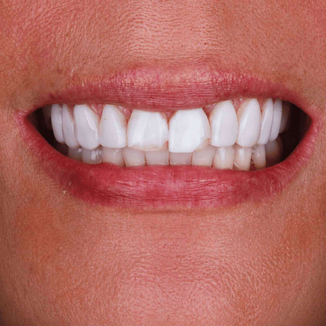 Cambio De Diseno De Resina Por Porcelana Imax En Un Tono Mas Plano Sin Efectos Traslucidos