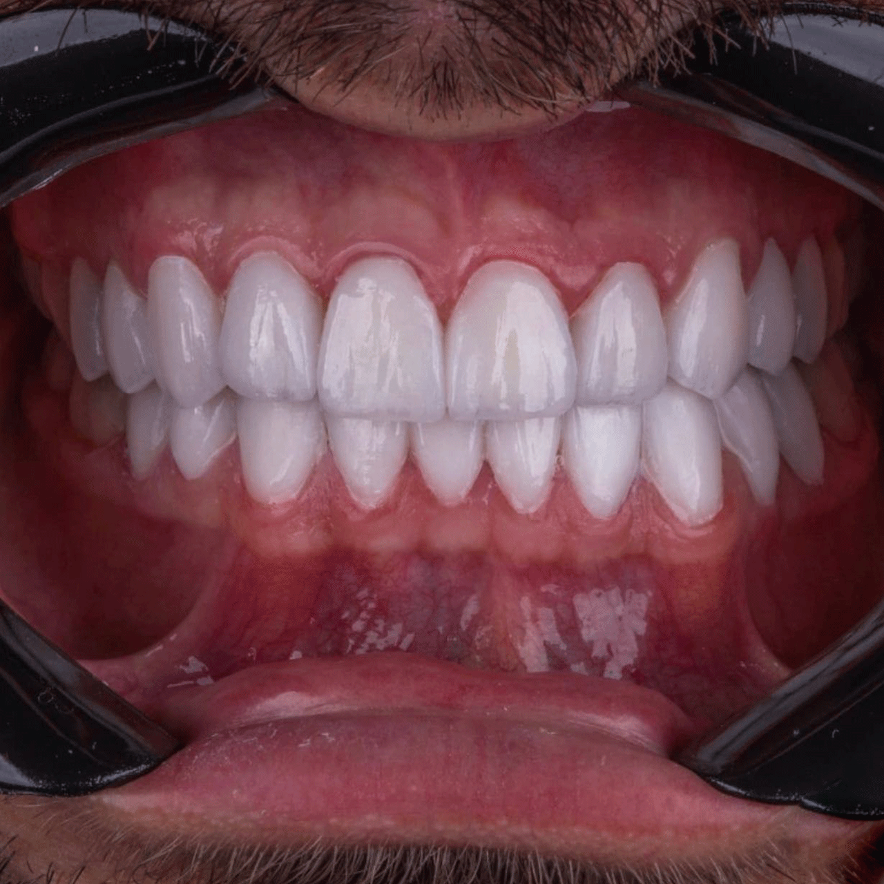 Diseno En Porcelana Imax Combinando Coronas Y Carillas Morfologia Y Traslucidas De Alto Impacto Estetico 2