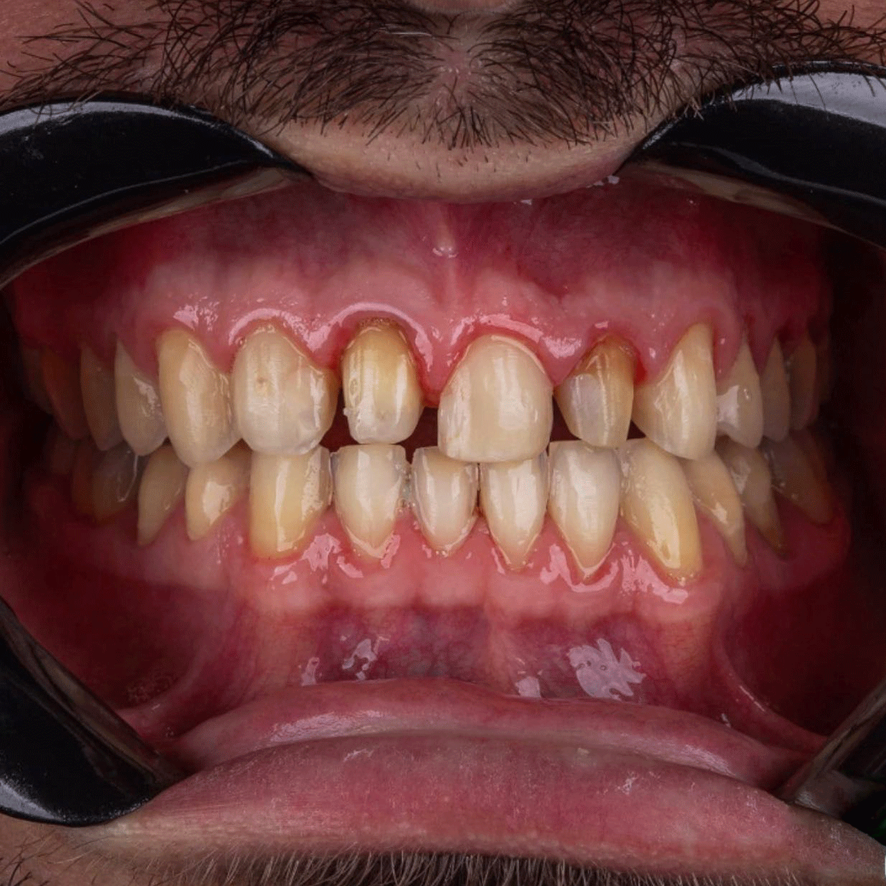 Diseno En Porcelana Imax Combinando Coronas Y Carillas Morfologia Y Traslucidas De Alto Impacto Estetico