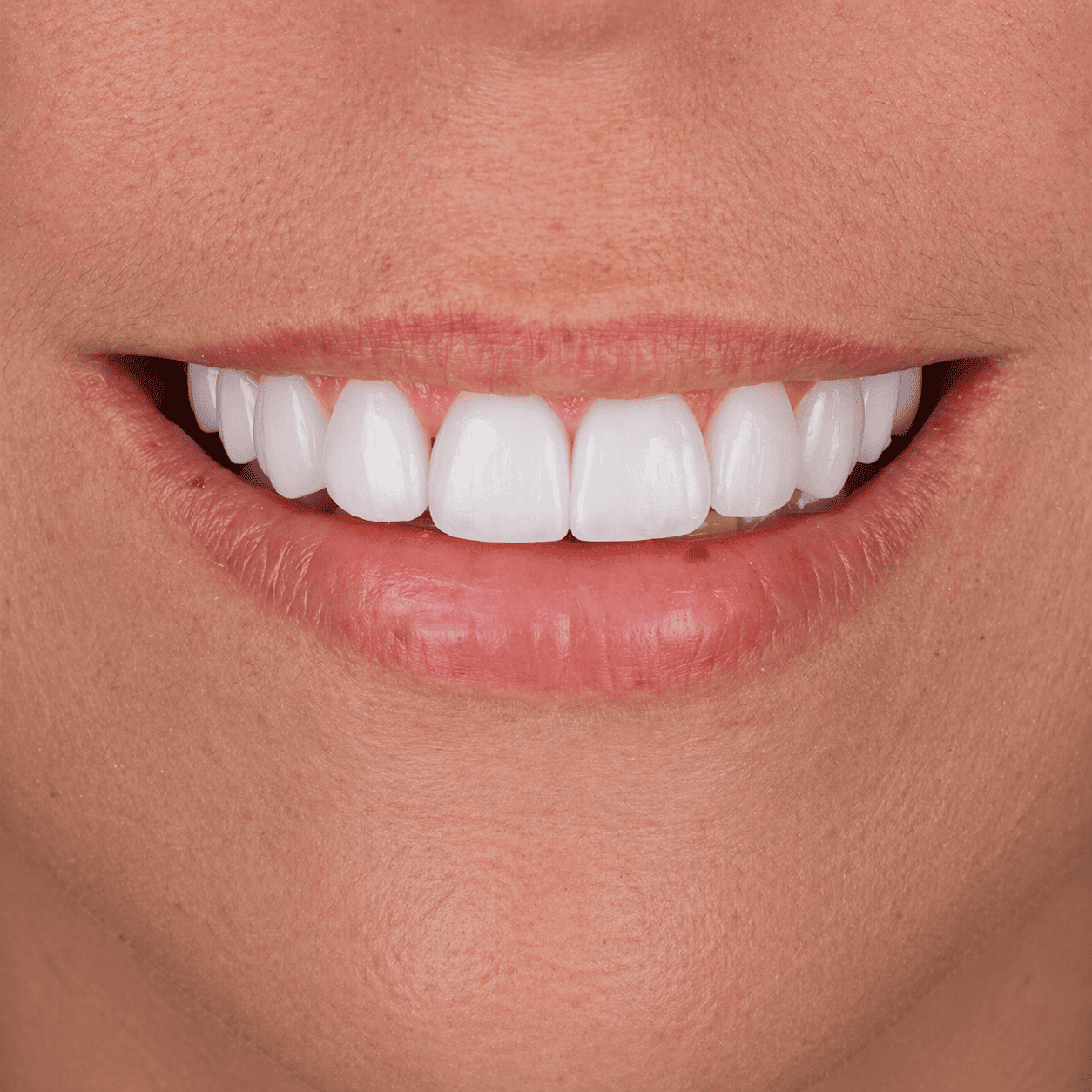 Diseno En Porcelana Imax Con Un Color Mas Claro Cierre De Espacios Y Mejorando La Linea De Sonrisa 2