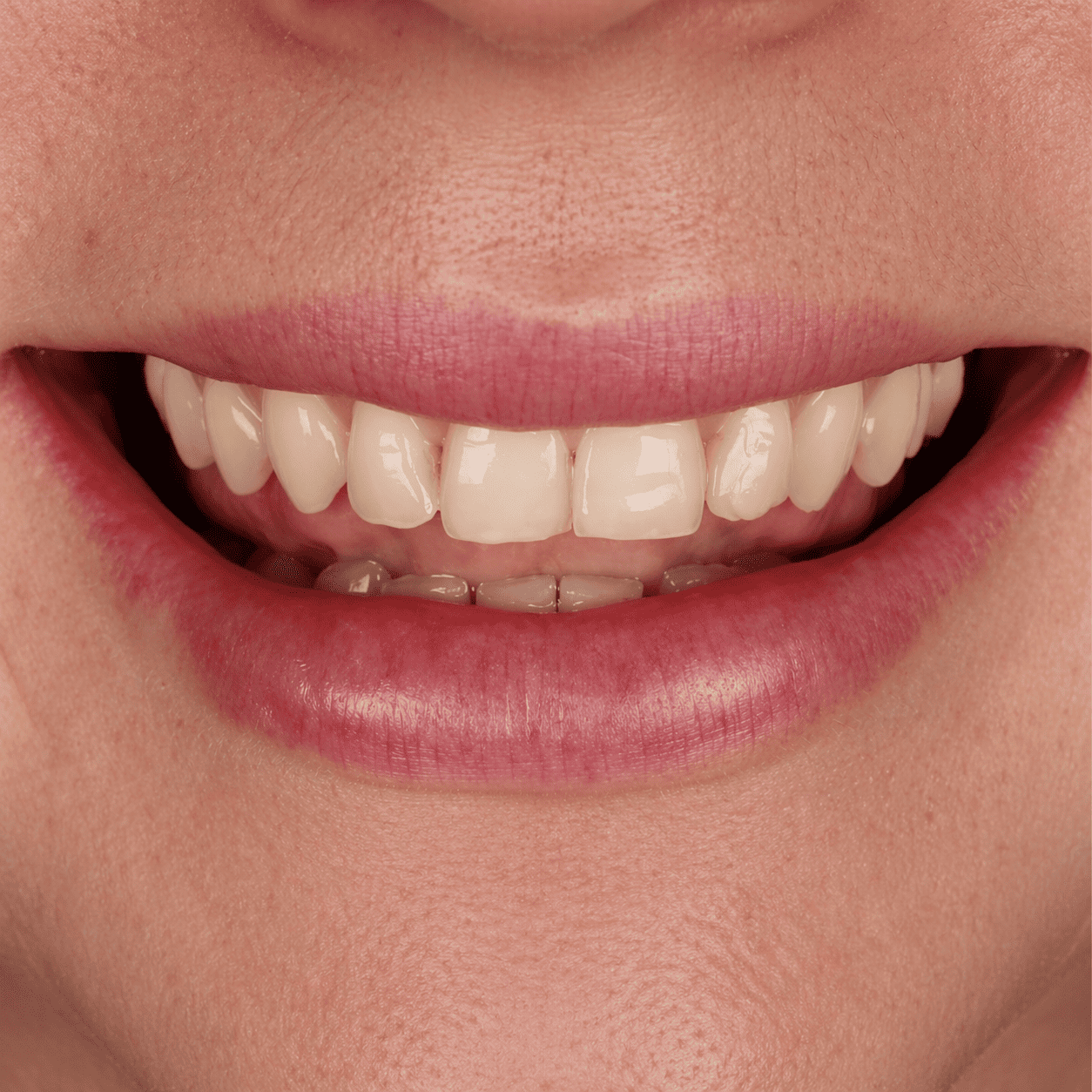 Diseno En Porcelana Imax En Un Color Mas Natural Con Efectos Traslucidos Y Alta Morfologia Estetica